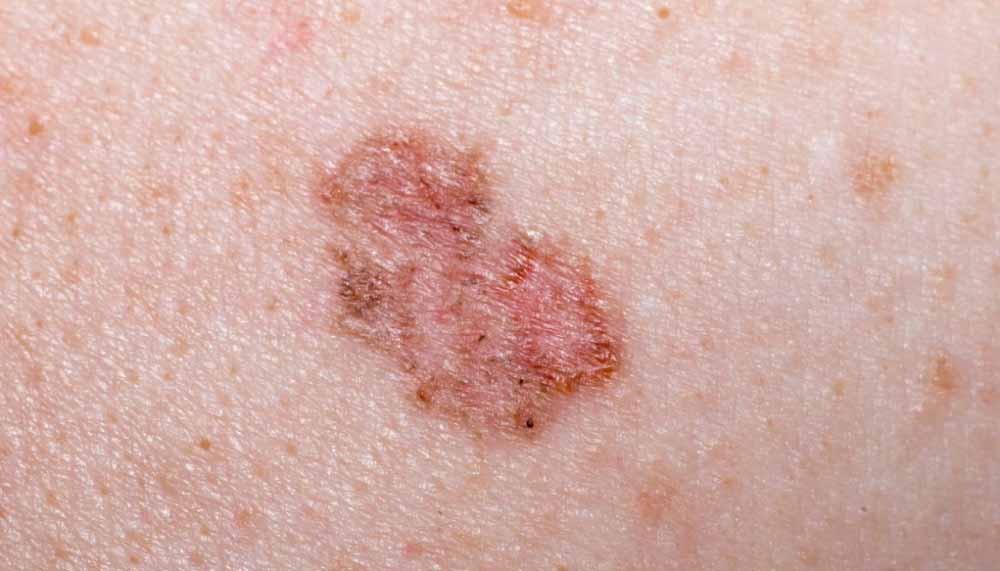 appearance-of-cancer